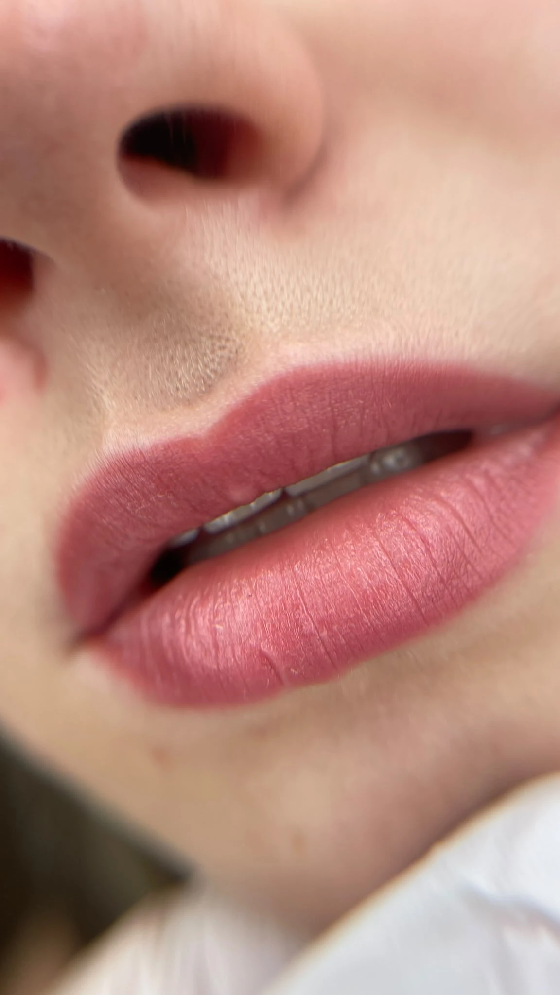 Seitliche Nahaufnahme abgeheilter Lippen mit weicher Kontur.
